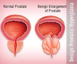 Best Treatment For BPH benign prostatic hyperplasia