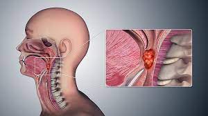 Treatment of Throat Cancer