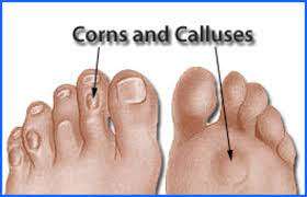 Treatment of Corn And Calluses