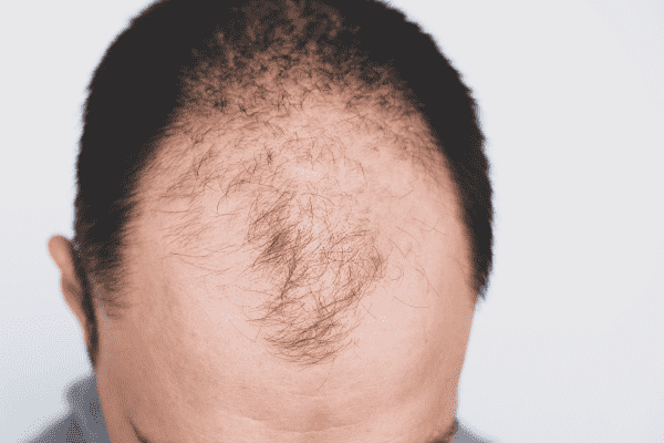 Homeopathy Treatment of Male Pattern Baldness