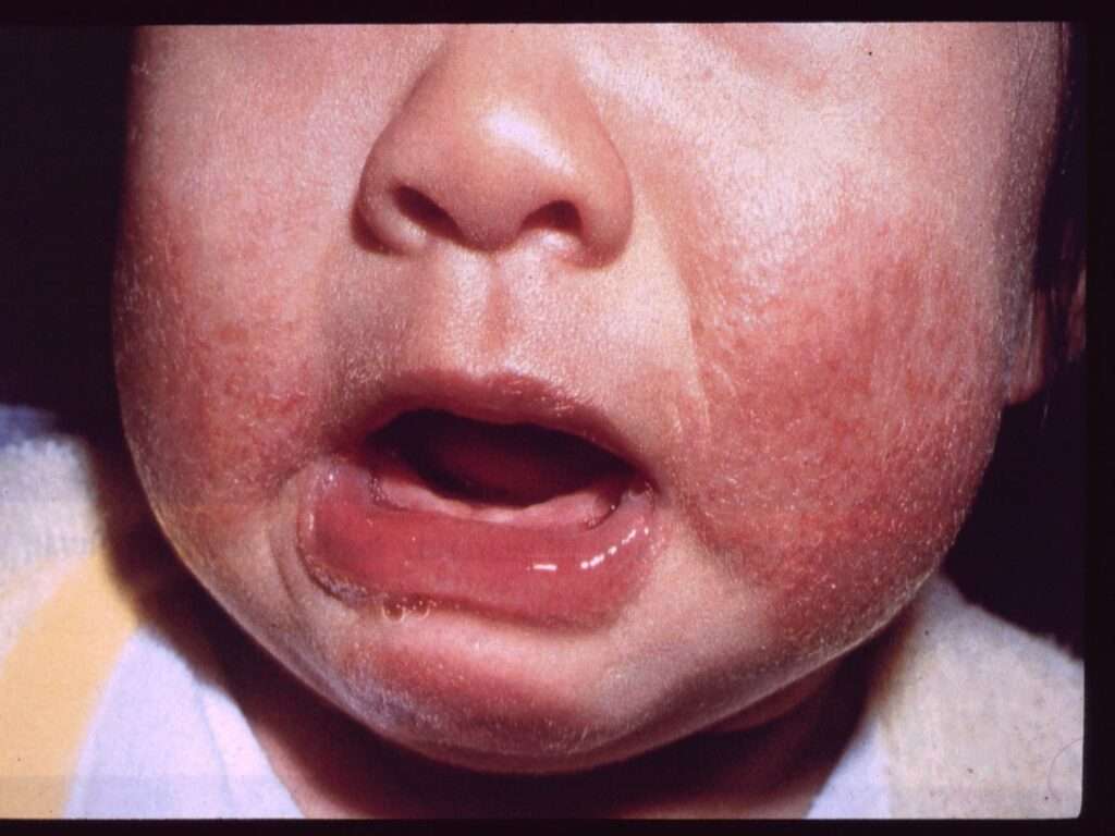 Eczema In Babies