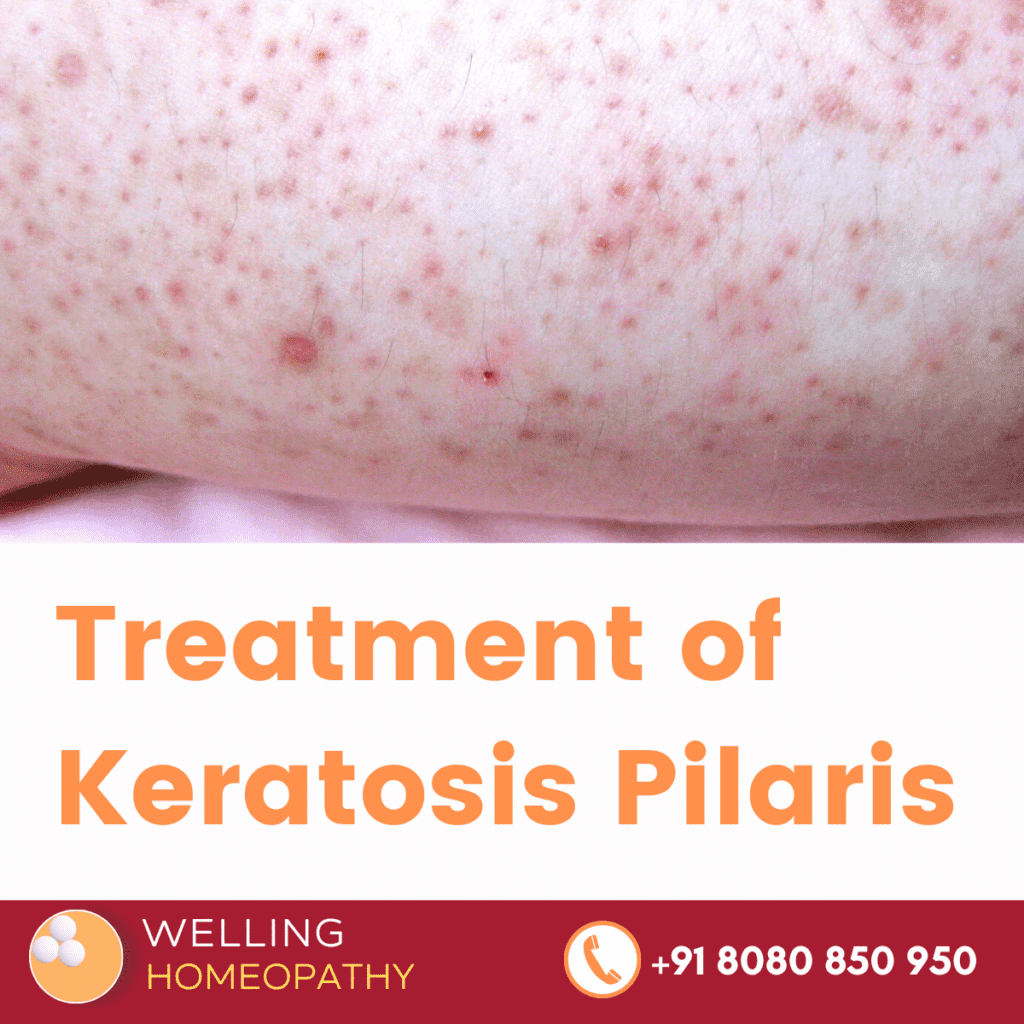 Treatment of Keratosis Pilaris