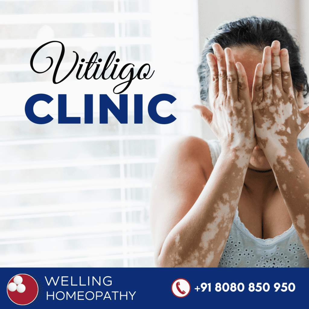 world's largest Homeopathy speciality clinic for Vitiligo treatment