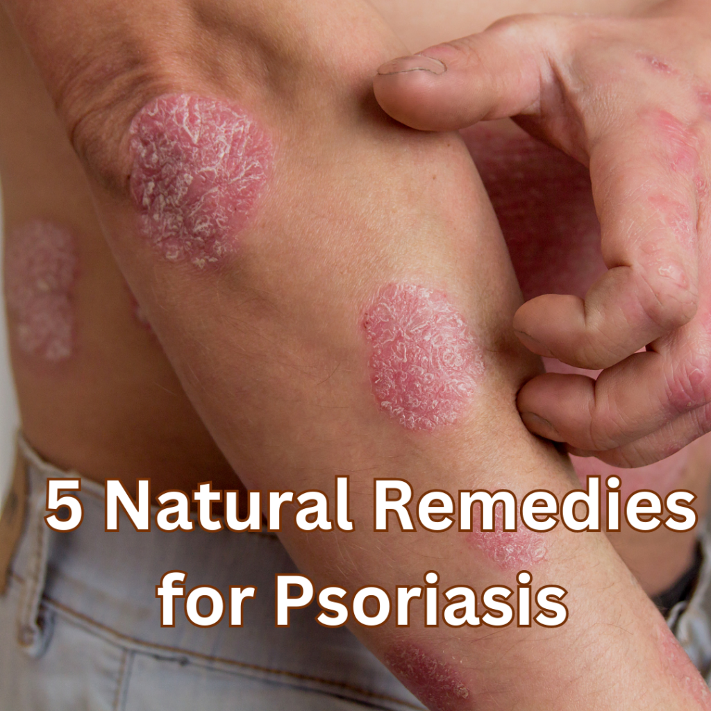 5 Natural Remedies for Psoriasis