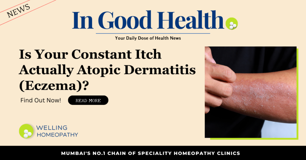 Is Your Constant Itch Actually Atopic Dermatitis (Eczema)? 