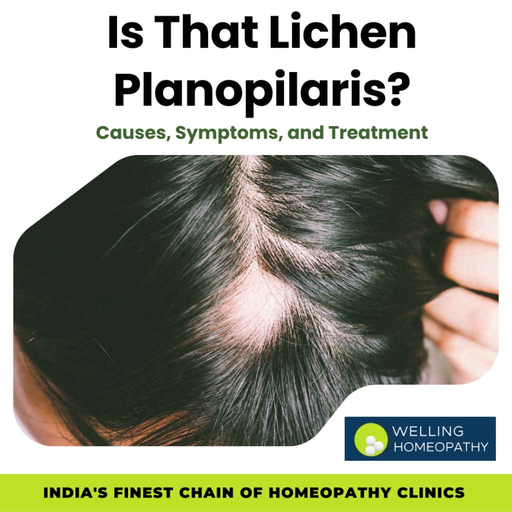Lichen Planopilaris: Causes, Symptoms, and Treatment
