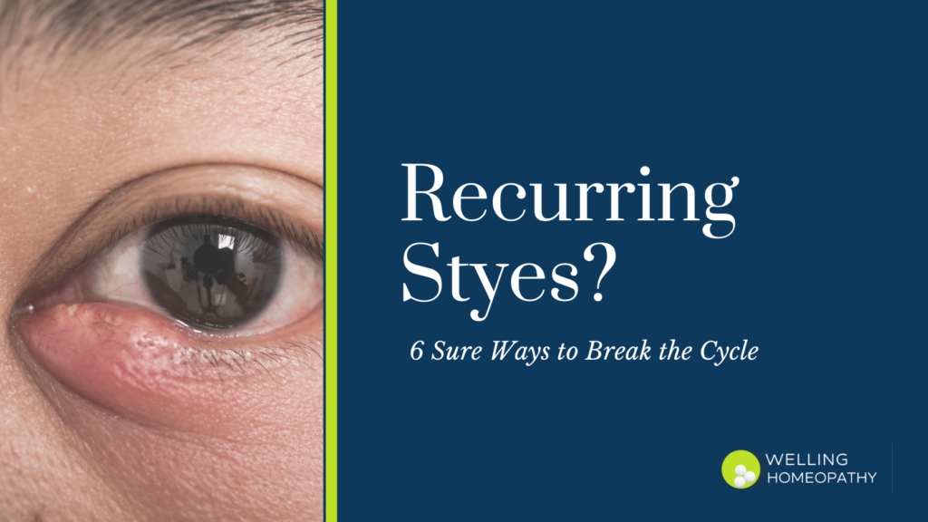 Recurring Styes? 6 Sure Ways to Break the Cycle