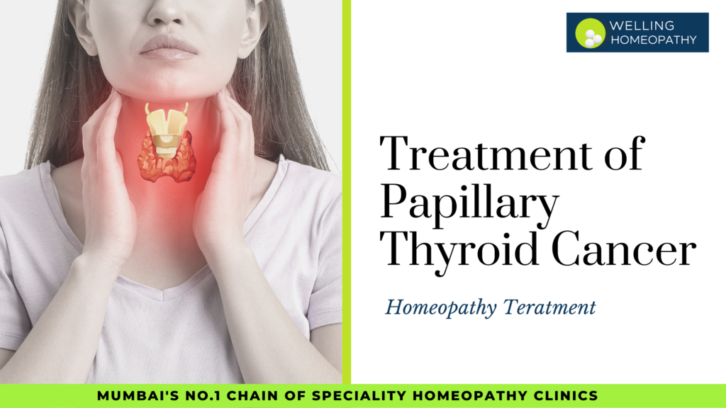 Homeopathy Treatment of Papillary Thyroid Cancer