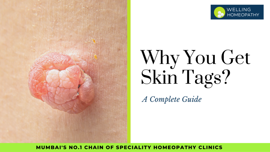 Why You Get Skin Tags? 