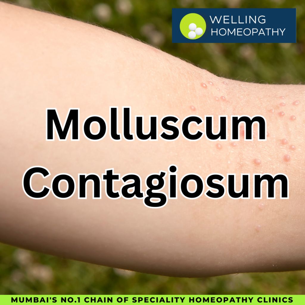 Home Remedies for Molluscum Contagiosum in Children