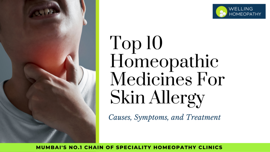 Top 10 Homeopathic Medicines For Skin Allergy