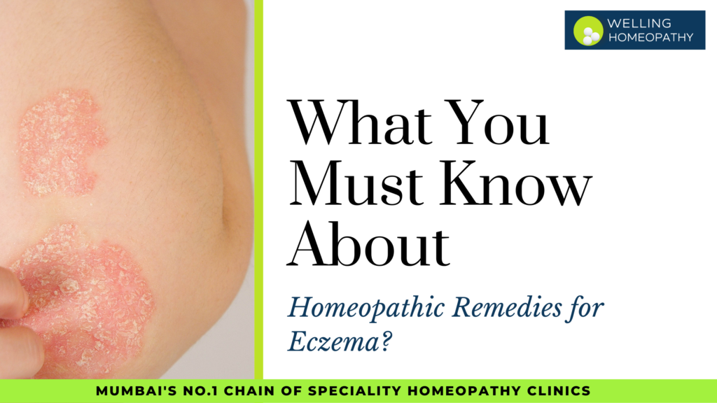 What You Must Know About Homeopathic Remedies for Eczema?