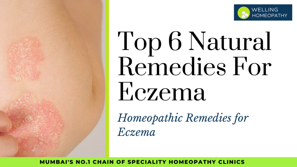 Top 6 Natural Remedies For Eczema