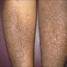 What is the best treatment for lichen planus?